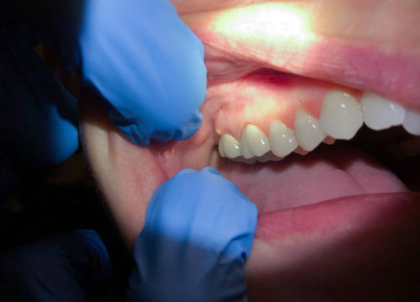 Best Emergency Tooth Extraction in Gilbert, AZ